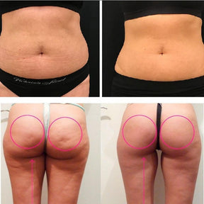 LipoPower - Non-Surgical Liposuction - Divine Beauty